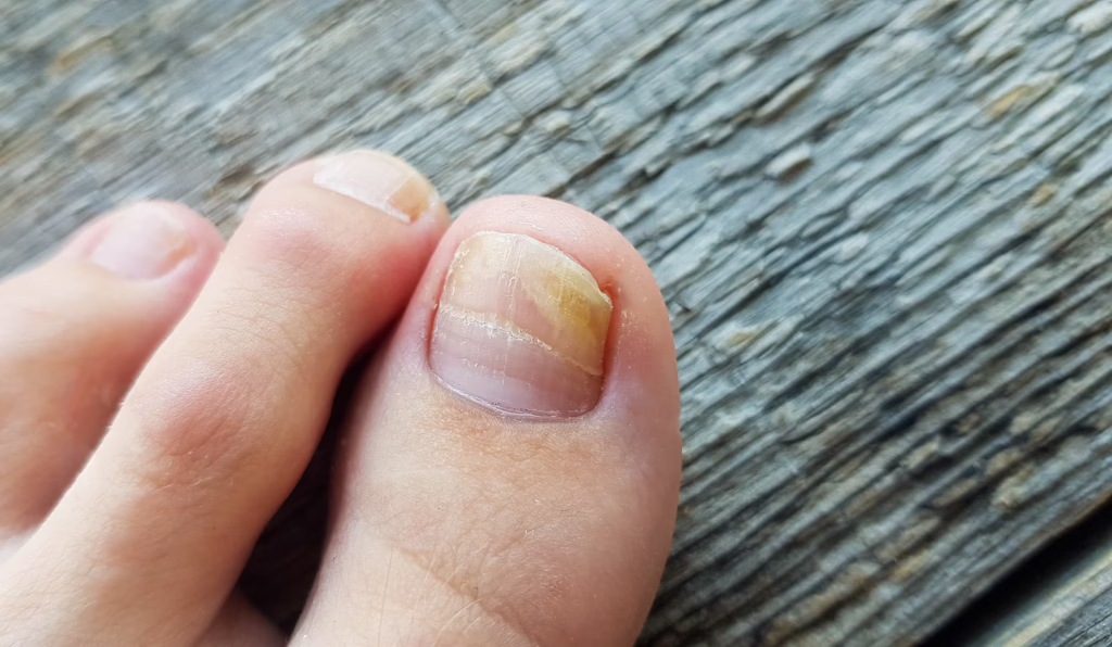 close up of a leg with a fungus on nails on a wood 2026 01 07 00 23 03 utc converted