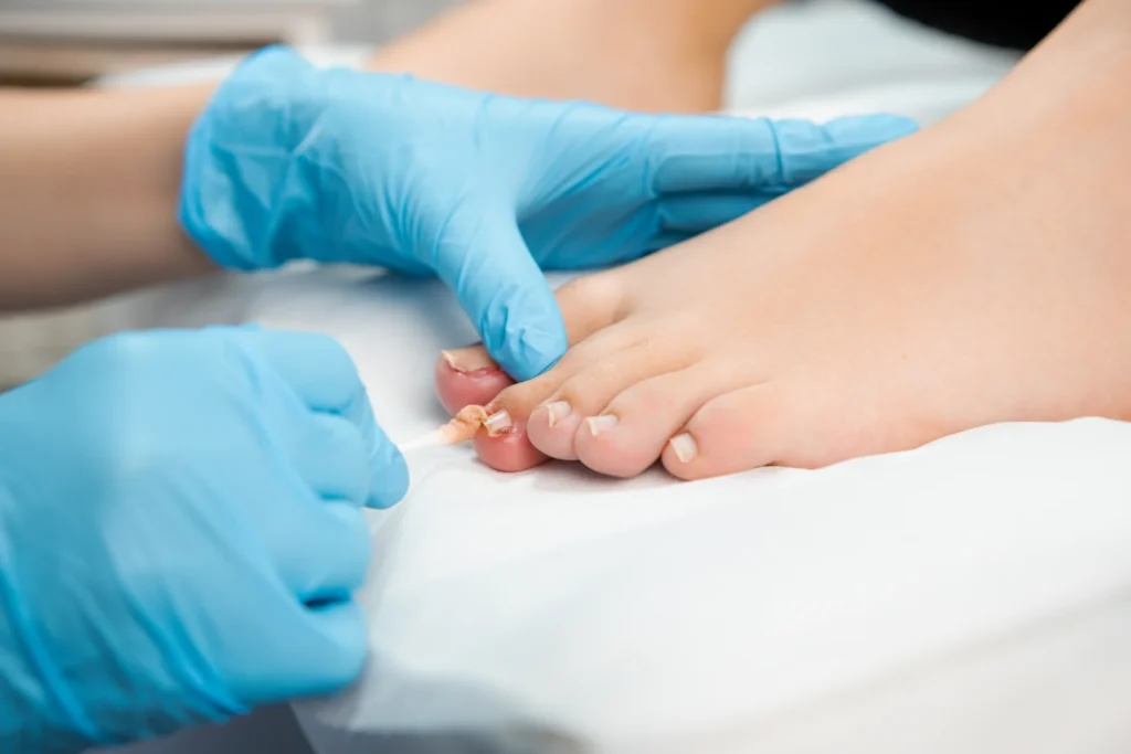 close up podologist treats the nail with an antifu 2026 03 25 09 49 22 utc